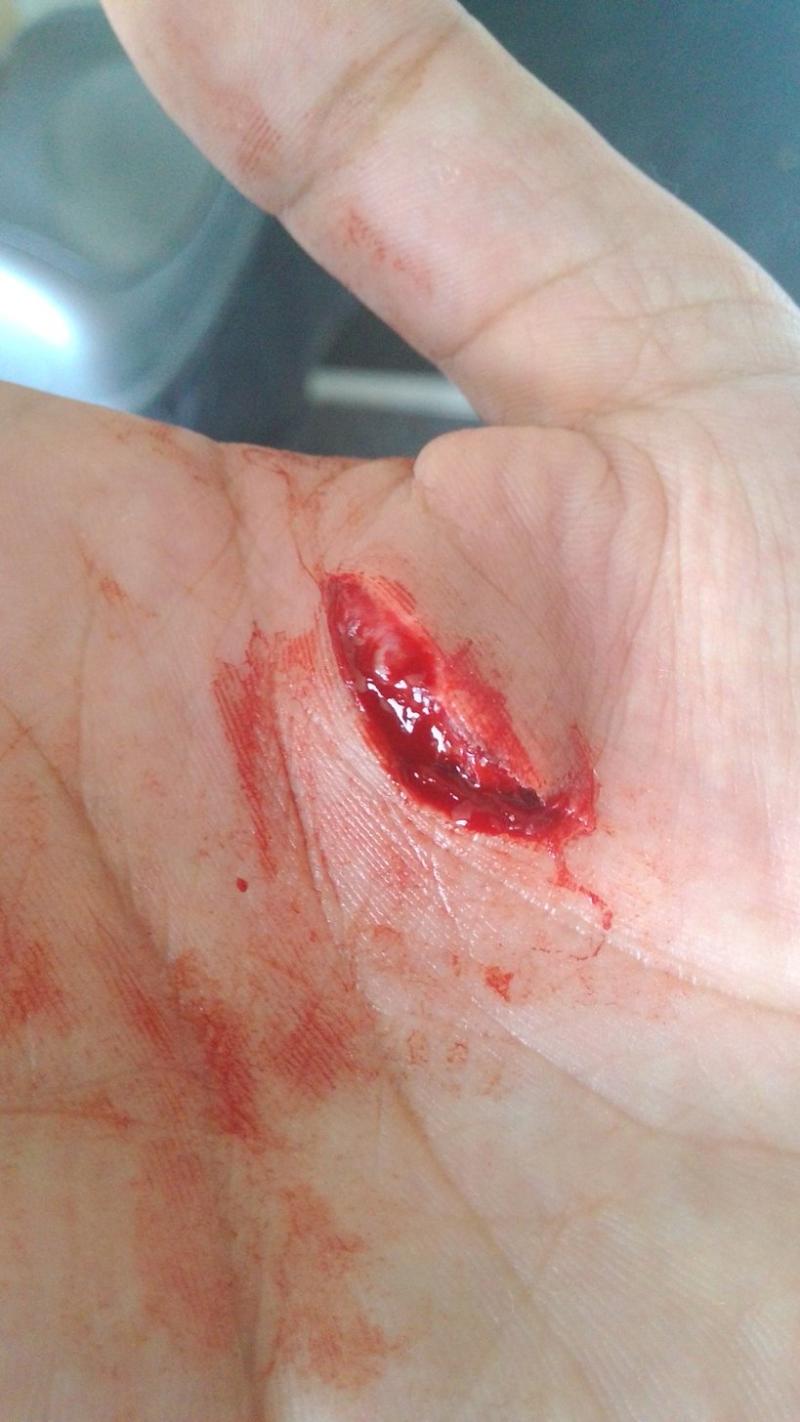 Lacerated Hand